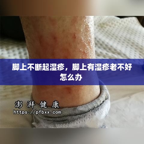 腳上不斷起濕疹，腳上有濕疹老不好怎么辦 