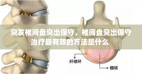 突發(fā)椎間盤突出保守，椎間盤突出保守治療最有效的方法是什么 